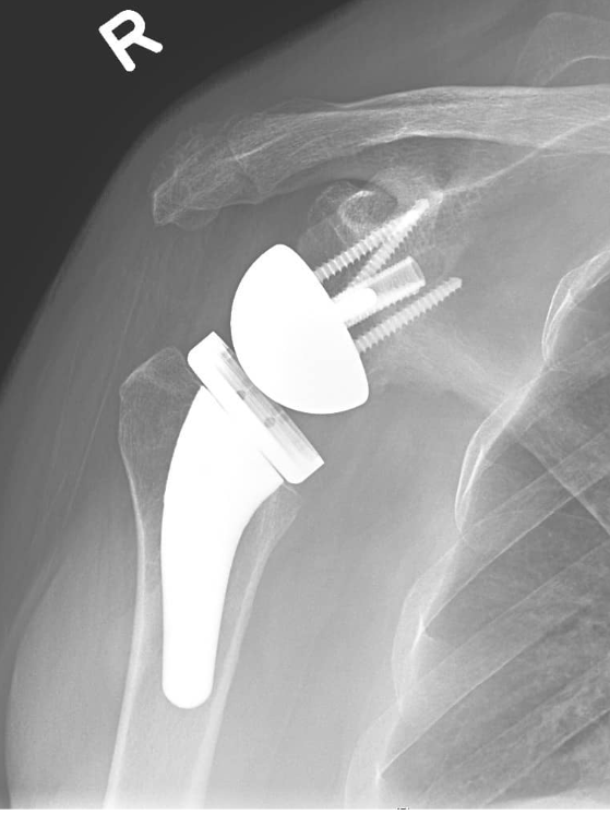 Shoulder Replacement Sydney | Action Rehab The Hands Physio