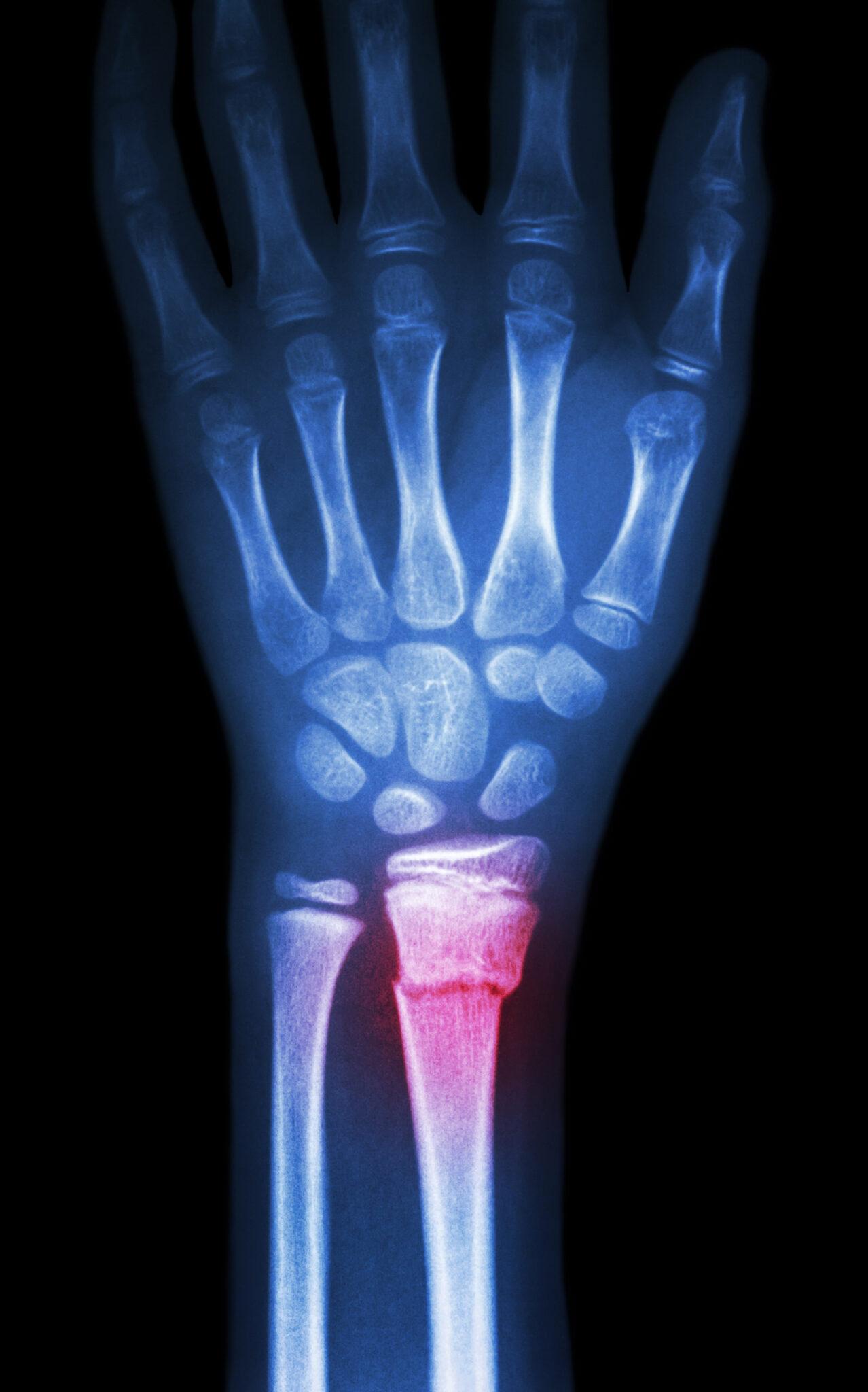greenstick-or-paediatric-buckle-fracture-treatment-sydney